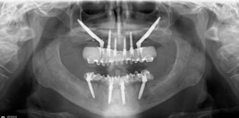 Tecnica Hybrid Zygoma per la riabilitazione di un mascellare atrofico