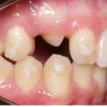 Canini inclusi e allineatori: la chirurgia è sempre necessaria?