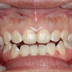 Morso aperto anteriore, i fattori che lo determinano Morso aperto anteriore