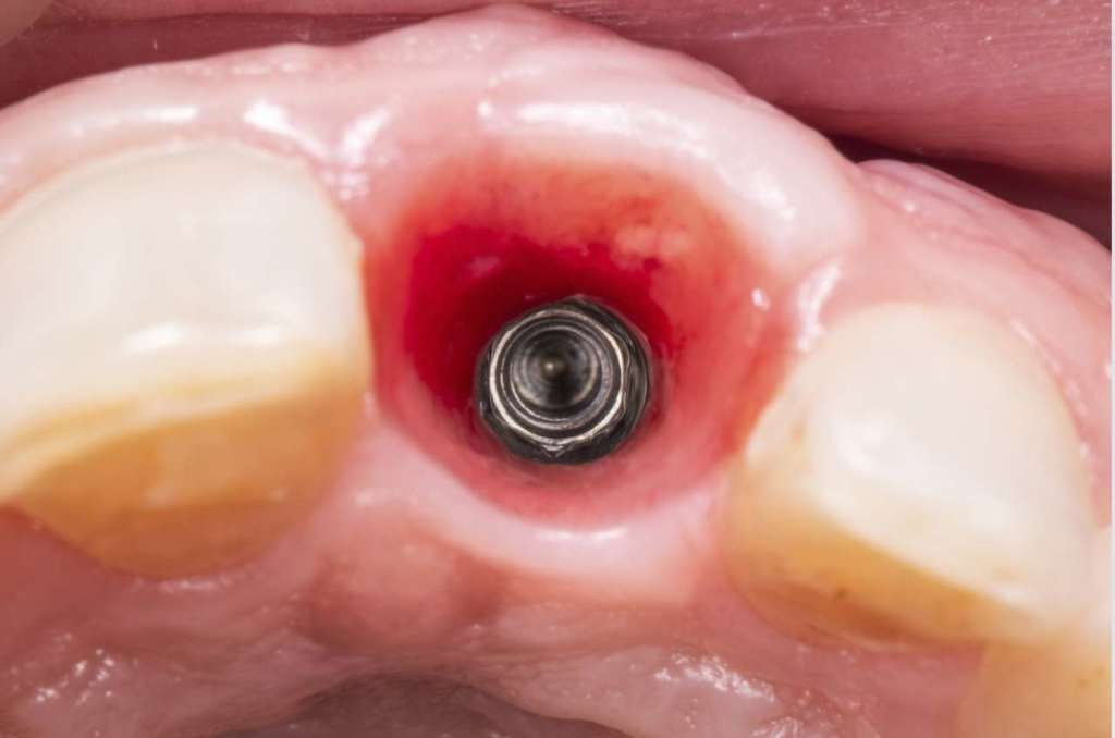 impianti osso crestale