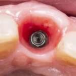 Impianti, le differenze di stress nell’osso crestale in base al posizionamento impianti osso crestale