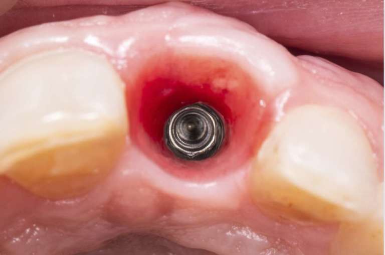 Impianti, le differenze di stress nell’osso crestale in base al posizionamento