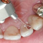 Tecnologia laser: nuovi trattamenti e protocolli in odontoiatria