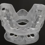 Riabilitazione post-estrattiva in zona estetica con chirurgia guidata