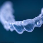 Allineatori ortodontici, gli effetti sul bruxismo diurno allineatori bruxismo