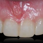 Allineamento Dentale Protesicamente Guidato (PGO): una nuova opportunità nella riabilitazione estetica con faccette