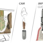 Sicurezza grazie all’implantologia a 360°