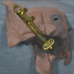 Riabilitazione di atrofie mascellari con nuove tipologie di dime per implantologia zigomatica atrofie mascellari