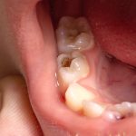 Carie della prima infanzia e carattere, esiste una correlazione Carie della prima infanzia