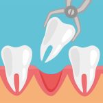 Le complicanze neurologiche post-intervento sui molari inferiori