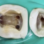 Casi complessi in endodonzia: il successo inizia prima, quando apri la cavità