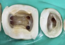 Casi complessi in endodonzia: il successo inizia prima, quando apri la cavità