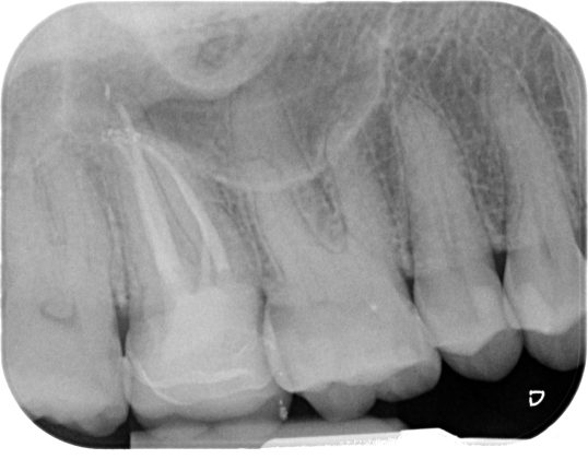 Endodonzia casi complessi
