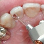 Il laser in odontoiatria conservativa