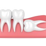 Pericoronite e caratteristiche anatomiche dei terzi molari inferiori inclusi Pericoronite