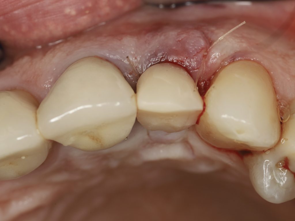 Impianyo post-estrattivo zirconia