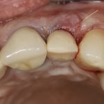 Impianto post estrattivo in area estetica con fixture monocomponente in zirconia Impianyo post-estrattivo zirconia