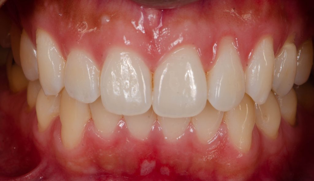 Recessioni gengivali