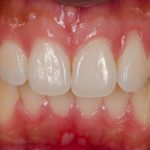 Recessioni gengivali, due tecniche chirurgiche a confronto Recessioni gengivali