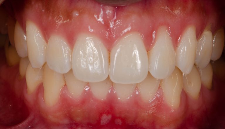 Recessioni gengivali, due tecniche chirurgiche a confronto