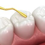 Odontoiatria restaurativa biomimetica, i miti da sfatare odontoiatria restaurativa biomimetica