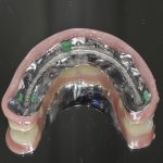 Chirurgia guidata. Riabilitazione di mascellare superiore con implantologia computer guidata e protesi su barra CAD-CAM: case report Chirurgia guidata