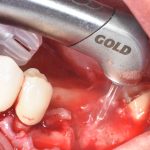 Laser e impianti dentali