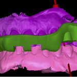 Chirurgia guidata: strumento indispensabile nella pianificazione chirurgica e protesica chirurgia guidata