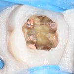 Parodontite apicale acuta secondaria dell’elemento 46: ritrattamento e controllo a un anno Parodontite