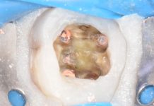 Parodontite apicale acuta secondaria dell’elemento 46: ritrattamento e controllo a un anno Parodontite