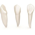 La gestione degli incisivi centrali mascellari inclusi secondo le linee guida Incisivi inclusi