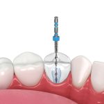 Terapie endodontiche, come valutarne la difficoltà secondo gli esperti terapie endodontiche