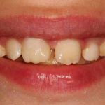 Compositi one-shade semplificare l’estetica quotidiana