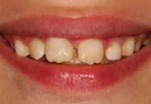 Compositi one-shade semplificare l’estetica quotidiana