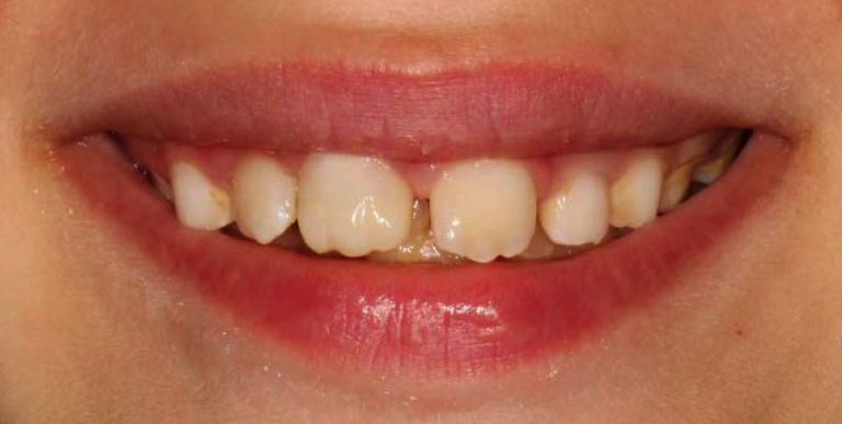 Compositi one-shade semplificare l’estetica quotidiana