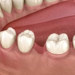 Perdita ossea: preservare l’alveolo post-estrattivo Perdita ossea alveolo