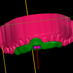 Chirurgia guidata e digitale vs analogico nella gestione del caso implantare in zona estetica Chirurgia guidata