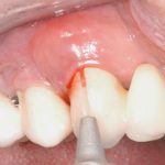 Il laser in parodontologia Laser in parodontologia