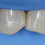 Moderne tecniche per lo studio del colore del dente e sua riproduzione nei restauri diretti anteriori Moderne tecniche colore