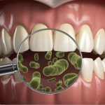 Infezioni microbiche del cavo orale e nuovi approcci terapeutici infezioni cavo orale