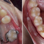 Chiusura degli spazi e mesializzazione con l’utilizzo di dispositivo DIVA