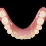 Carico immediato su overdenture mandibolare carico immediato