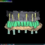 Chirurgia guidata: flusso digitale e scansioni facciali per riabilitazioni complete su impianti chirurgia guidata