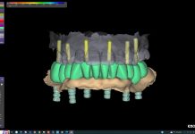 Chirurgia guidata: flusso digitale e scansioni facciali per riabilitazioni complete su impianti chirurgia guidata