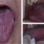 Celiachia: non solo intestino, anche la bocca ne soffre celiachia bocca