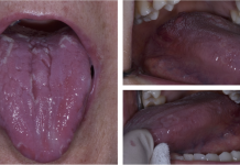 Celiachia: non solo intestino, anche la bocca ne soffre celiachia bocca