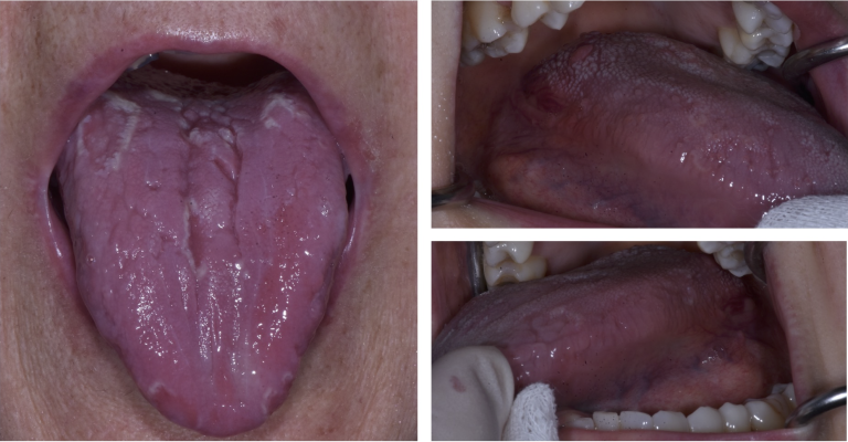 Celiachia: non solo intestino, anche la bocca ne soffre