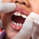 Carie precoce nei bambini: fattori di rischio e prevenzione carie precoce bambini