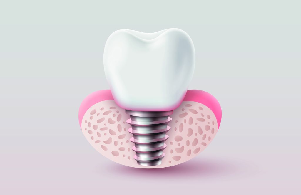aumento cresta alveolare TST