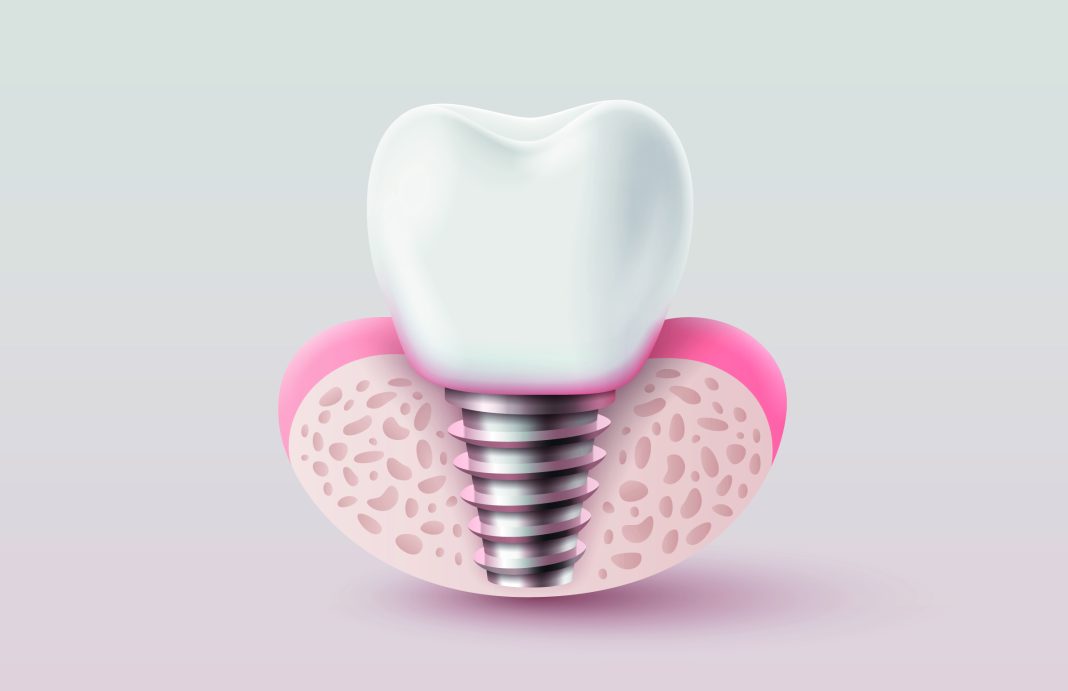 aumento cresta alveolare TST